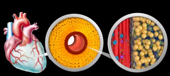 Herz Ablagerung FAI Herz Ablagerung FAI