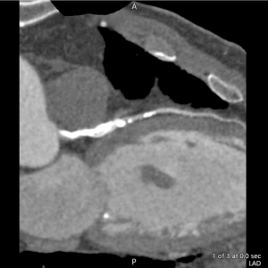 RIVA CT Angiografie ohne Subtraktion