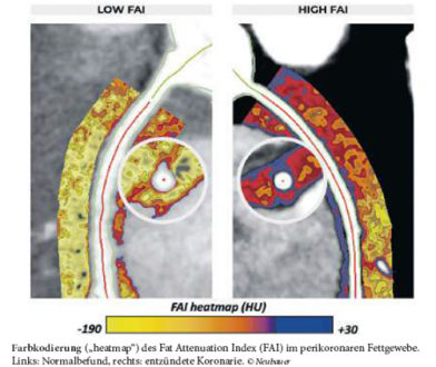 CardioNews FAI heatmap